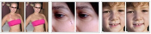 Skin photo retouching services to remove blemishes
