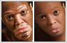 Vitiligo (leucoderma) patches removed with photo editing