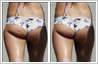 Cellulite removal from legs, thighs and buttocks done with photo retouching.