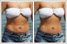 Photo retouching has been carried out to remove wrinkles around navel. Also to fix loose skin and stretch marks.