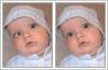 Squint eye correction carried out on baby