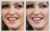 Teeth gap correction on Madonna's front teeth