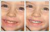 Teeth whitening in photos