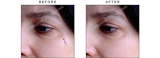 Photo editing: The stitches / suture marks have been cleared away. On left is the same photograph before photo editing.