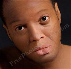 Vitiligo / leucoderma / white patches on man's face, cleared with photo editing