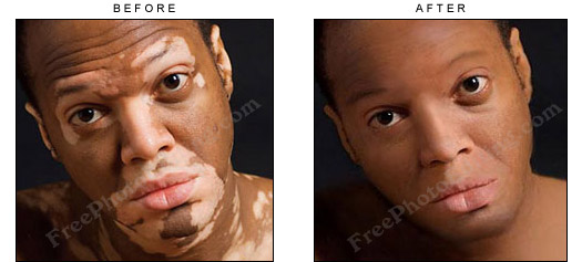 Vitiligo / leucoderma / white patches on man's face, cleared with photo editing