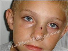 Minor injuries on boy's face