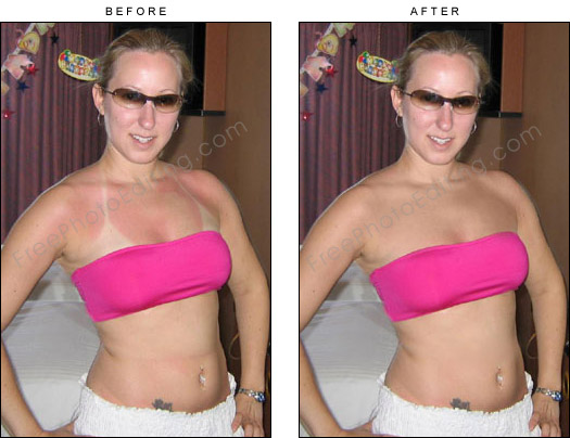 This is a photo editing example in which extensive tan lines and sunburn have been removed with retouching. Original photo can be seen on left.