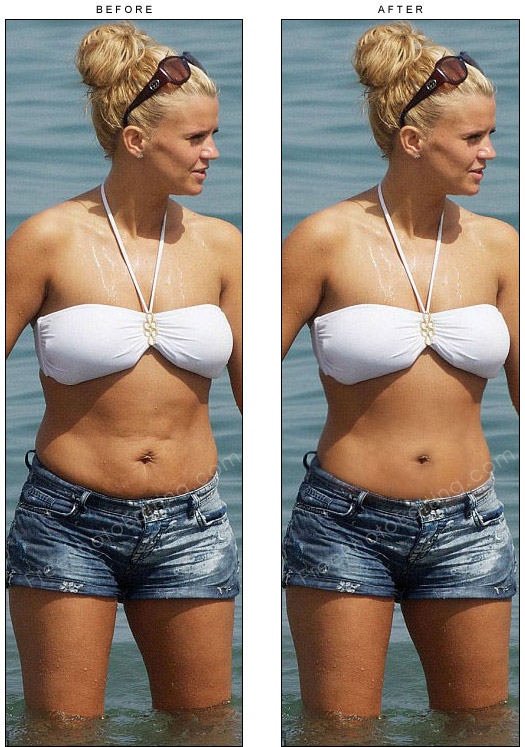 This is a photo retouching example of virtual umbilicoplasty. Wrinkles, sagging skin and stretch marks around the belly button have been removed with photo editing.