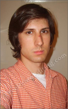 Photo editing example [Blemish removal]: This is a photograph in which there is a boil on the young man's nose which needs to be fixed. 
