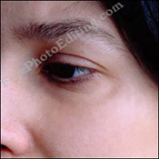 Photo editing: The stitches / suture marks have been cleared away. On left is the same photograph before photo editing.