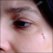 Photo editing example [Blemish removal]: This photograph shows stitches / suture marks on the lady's face that need to be edited out.