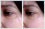 Photo editing example [Blemish removal]: The surgical stitches / sutures need to be cleared away from the lady's face.