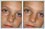 Injury marks removed with photo retouching