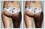 Cellulite removal from legs, thighs and buttocks done with photo retouching. 