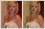 Unwanted bra straps covered with photo editing and touch-up