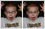 Digital correction of squint eye done with photo editing.