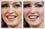 Teeth gap correction on Madonna's front teeth