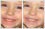 Teeth Whitening