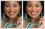 Teeth Whitening