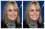 Diane Keaton's discoloured teeth have been bleached / cleaned / whitened
