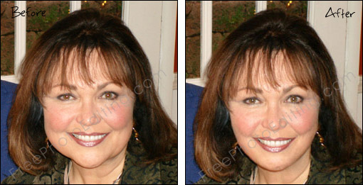 Sagging jowls lifted with digital cosmetic surgery. The original photo before photo editing can be seen on left.