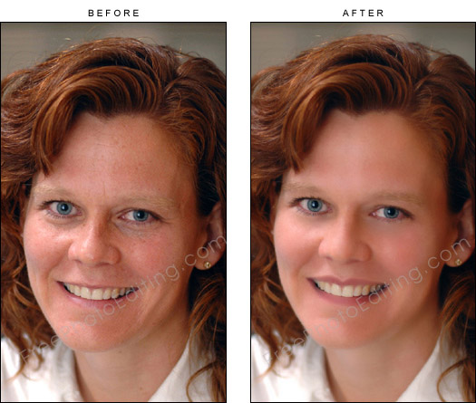 This is a photo retouching example of natural looking skin smoothing and lip plumping. Under eye bags and age lines have also been removed.