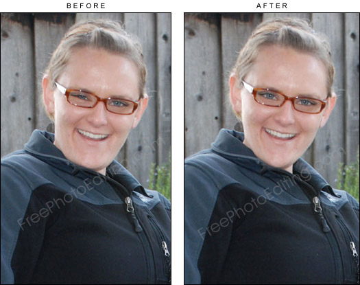 This is a photo editing example in which a girl's squinchy eye has been corrected without surgery. Also a large chin reduction procedure has been carried out virtually.
