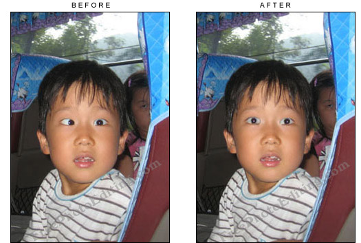 Squint in the boy's right eye has been corrected using photo editing.