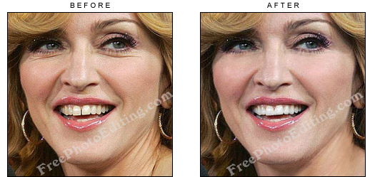 Edited photograph in which the gap between pop singer Madonna's front teeth has been bridged with the use of digital cosmetic dentistry.