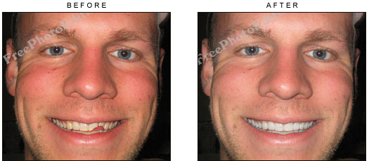 Partially broken teeth fixed with photo editing. Digital repair alternative for cosmetic dentistry.