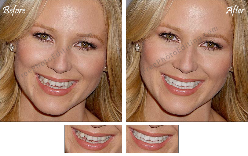 Repairing a chipped or broken tooth with photo editing.