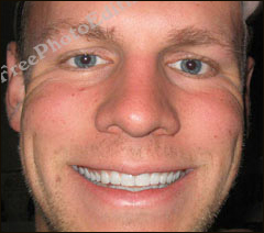 Partially broken teeth fixed with photo editing. Digital repair alternative for cosmetic dentistry.