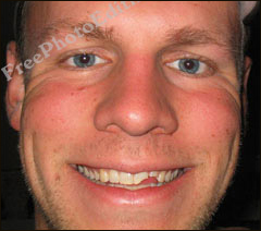 Fixing Chipped Teeth