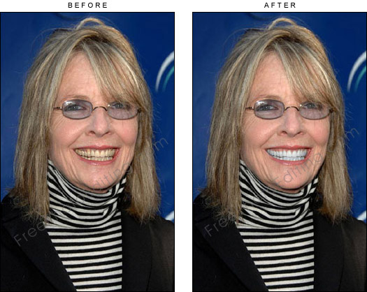 This is a photo editing example of teeth whitening, Diane Keaton's in this case.