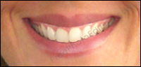 Reshape your lips. Add volume to your lips without injections or implants. Have the best pout in town!
