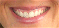 This customer wants a lip augmentaion procedure without infections, lip implants or surgery. See photo retouching results on right.