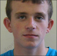 Photo editing job: The young man in this photograph is fed up with his ears sticking out. He wantsplastic surgery done to have his ears pinned back. The look after virtual otoplasty can be seen on right.