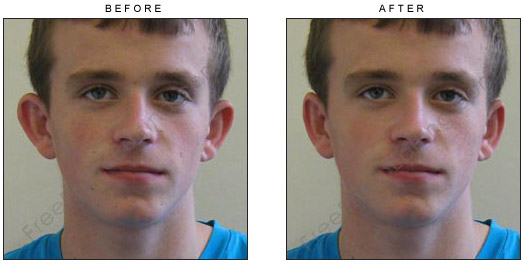 Virtual otoplasty surgery to pin ears back with photo editing.